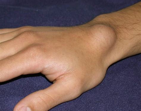 Ganglion Cyst Wrist - Pictures, Treatment, Surgery, Causes, Symptoms