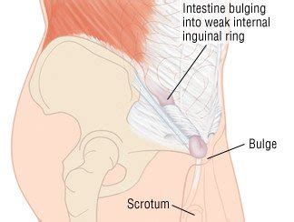 Inguinal Hernia Guide: Causes, Symptoms and Treatment Options