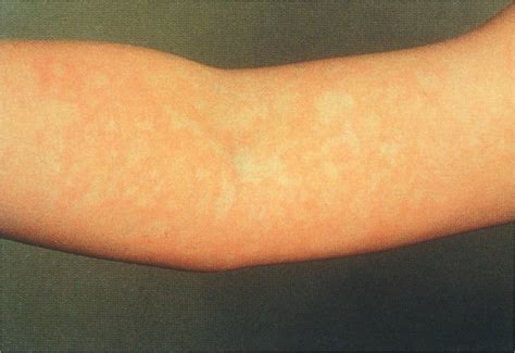 Reticular Rash Fifth Disease