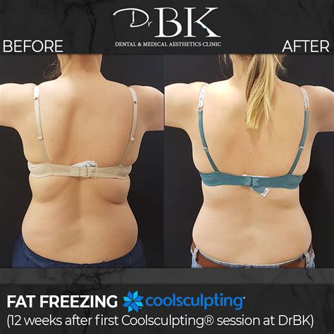 Coolsculpting® Fat Freezing Treatment - DrBK Clinic in Reading