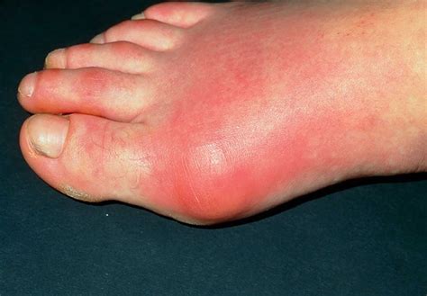 Gout causes, prevention, signs, symptoms, diagnosis & treatment