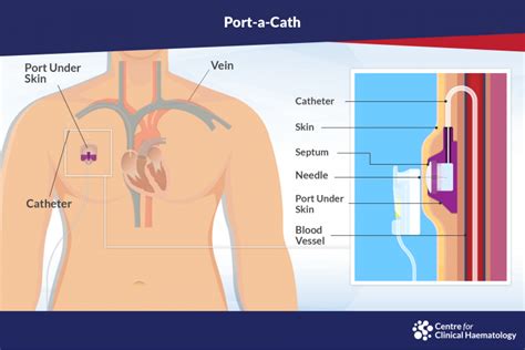 Port-a-Cath | CFCH | Centre for Clinical Haematology