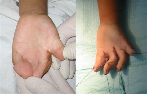 Hand Surgery Before And After | Luis is a four year old who … | Flickr