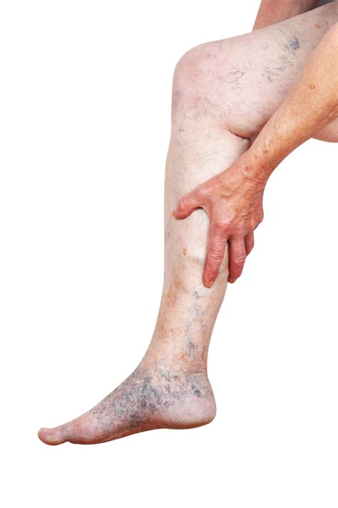 what ankle veins mean. Archives | La Jolla Vein & Vascular | Accredited Center