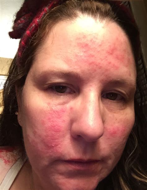 Lupus butterfly rash ? Or is this rosacea? | Lupus rash, Skin disorders, Lupus butterfly rash