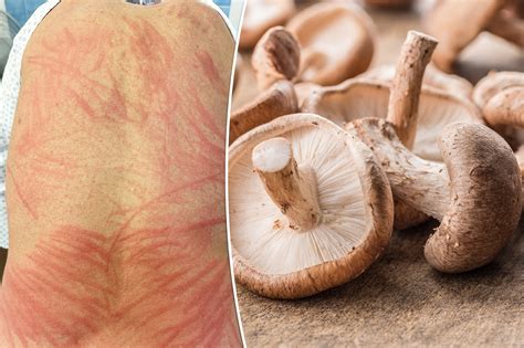 Man suffers rare ‘shiitake rash’ from undercooked mushroom