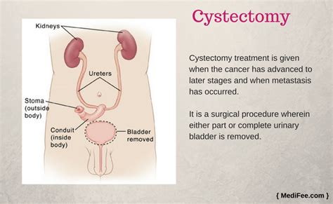 Bladder Cancer Surgery: Procedure, Risks and Associated Complications