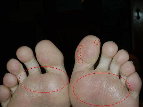 tiny holes on bottom of feet - pictures, photos