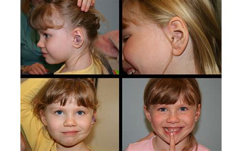 Ear Surgery Gallery | St. Louis Children's Hospital