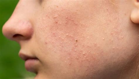 Fungal Acne - The reason your acne treatment may not be working