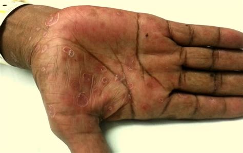 Diagnose on Sight: Palmar Rash – MED-TAC International Corp.