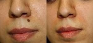 Mole Removal Prices, Costs | Skin Surgery Laser Clinic