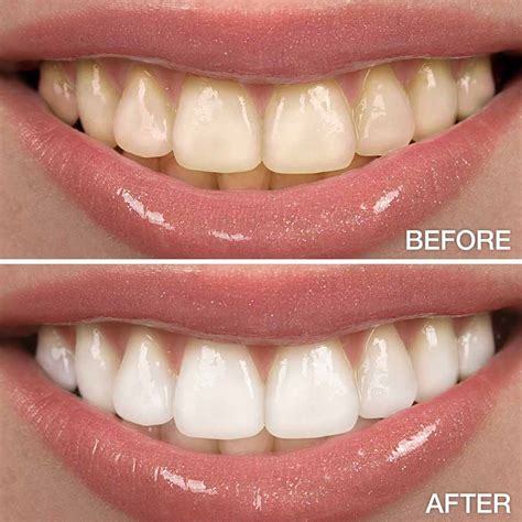 11 Ideal Teeth-whitening Products, According To Dentists 2024