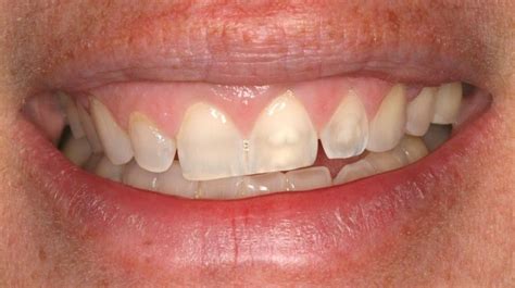 Canted Smile Guide: 7 Reasons for the Unaesthetic Canted Smile and What Cosmetic Dentists Can Do ...