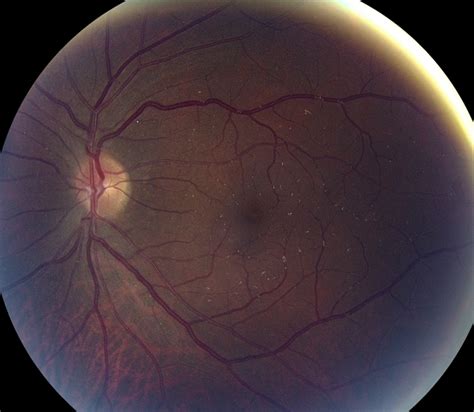 Talc Retinopathy - Retina Image Bank