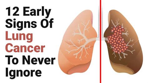 12 Early Signs Of Lung Cancer To Never Ignore