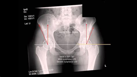 dysplasia xrays - YouTube