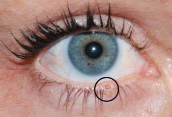 Madarosis: loss of eyelashes and eyebrows | Blog Pilochka