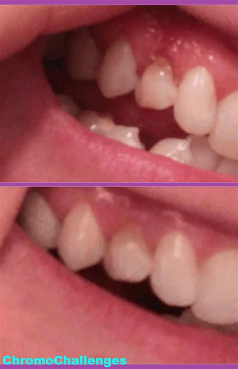 Tooth Remineralization Journey – ChromoChallenges