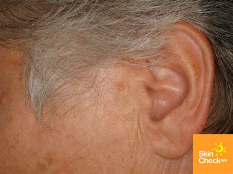 BCC-anterior-ear-1.jpg (1024×768) | Cancer, Ear