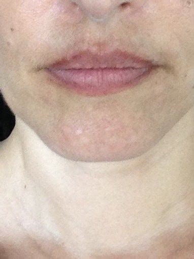 Discolored Skin Around Lips | Lipstutorial.org