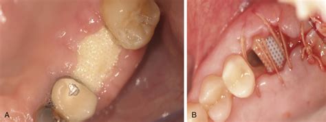 Bone Grafting Complications | Pocket Dentistry