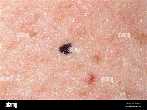 Benign mole. Melanocytic (pigmented) naevus, also known as a mole, on the skin of an 18 year-old ...