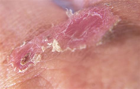 Macro Image Shows Second Degree Burn Wound Healing Stock Photo ...