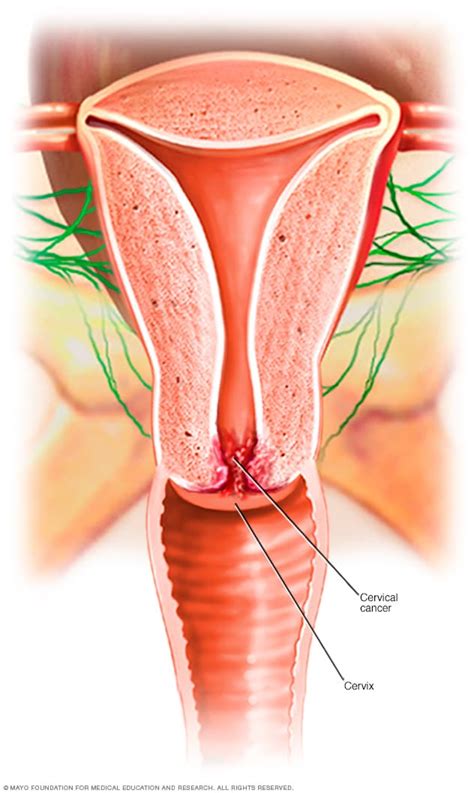 Cervical cancer - Symptoms and causes (2022)