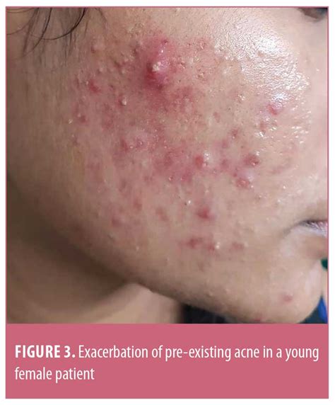 Facial Mask-related Acne and Acneiform Eruption During the Coronavirus ...