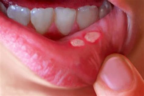 Aphthous Ulcer In Lipstick | Lipstutorial.org