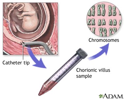 Chorionic villus sampling - series—Results: MedlinePlus Medical Encyclopedia