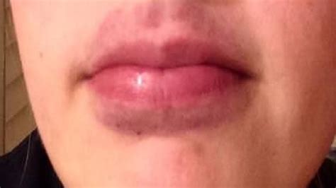 how to get rid of bruises on your lips fast - YouTube