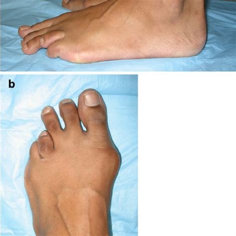 AP radiograph of the left foot demonstrating brachymetatarsia of the... | Download Scientific ...