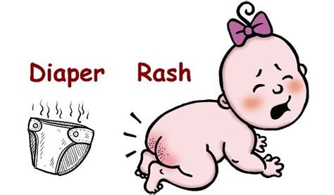 Home Remedies for Diaper Rash, How to Get rid of Diaper Rash