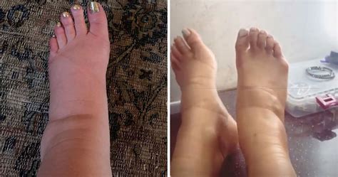 Swollen Feet During Pregnancy & Why It Happens, Explained