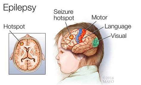 medical illustration of a brain with epilepsy; a seizure hotspot; and the motor, language and ...