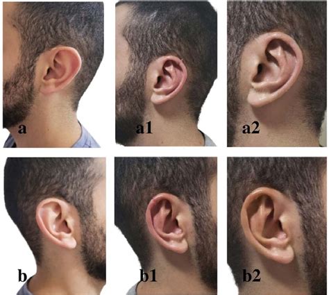 ((a), (b)). Before macrotia surgery. ((a1), (b1)). 3 months after... | Download Scientific Diagram