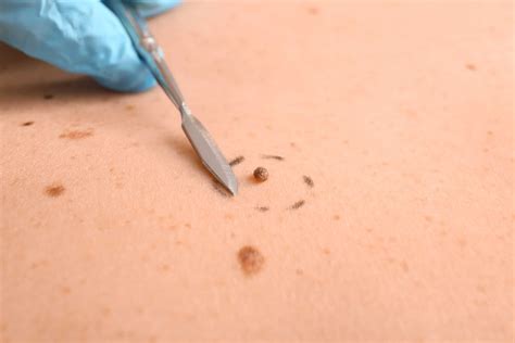 Mole Removal: What is a skin tag and how do I get rid of it? - Skin ...