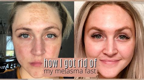 MUSELY SPOT CREAM - HOW I GOT RID OF MY MELASMA FAST WITH #MUSELY ...