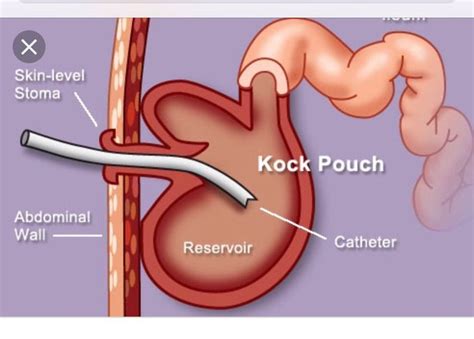 Ever heard of a Kock pouch also known as a continent - MEDizzy