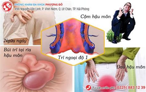 Biểu hiện bệnh trĩ ngoại cấp độ 1