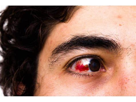 Blood in the Eye - Consumer Health News | HealthDay