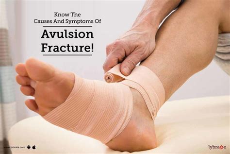 Know The Causes And Symptoms Of Avulsion Fracture! - By Dr. Rahul ...