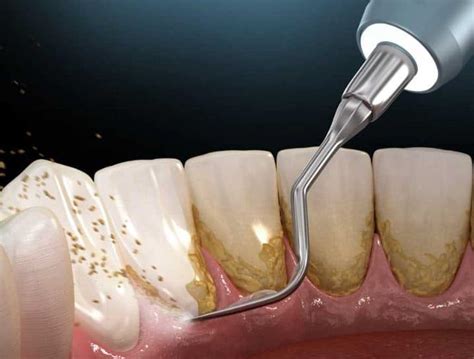 Remove Dental Plaque to Achieve your Best Smile & Improved Oral Health