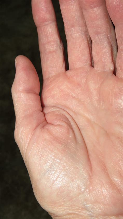 Free stock photo of basal joint arthritis, thumb arthritis