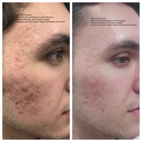 Acne Scar Laser Treatment & Removal London | Dr H Consult