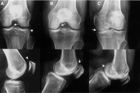 Artrosis de rodilla: mejora del tratamiento y reducción de costes ...