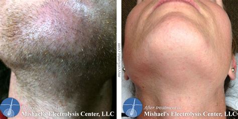 Before & After Electrolysis Hair Removal | Mishael's Electrolysis Center