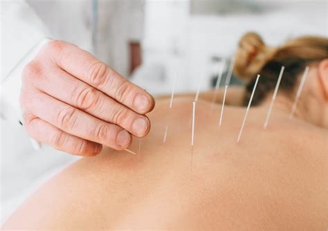 Dry Needling – Back to Action Chiropractic & Rehab